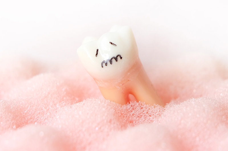 歯周病は「歯を失う一番の病気」